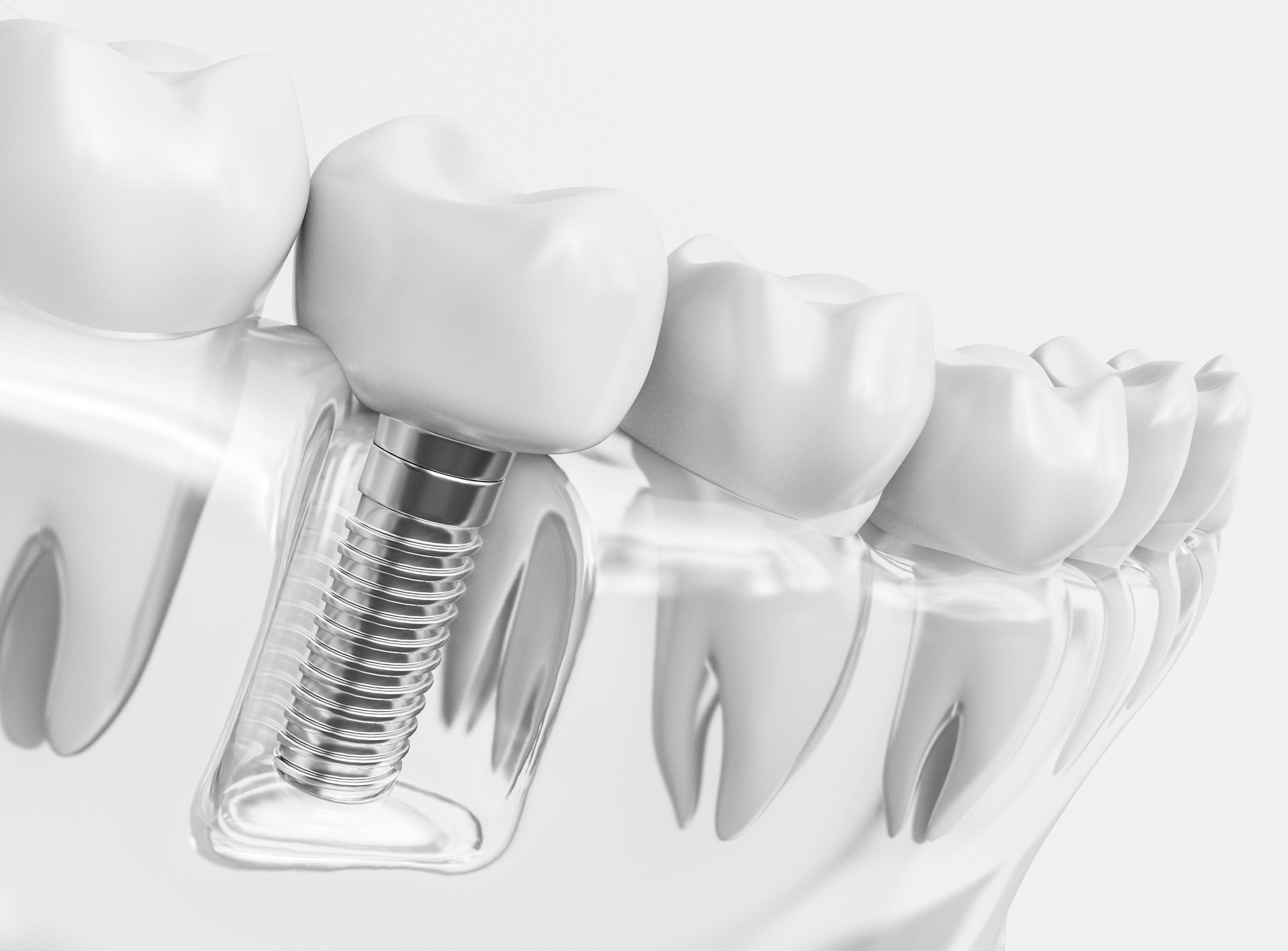Thousand Oaks Implant Dentist